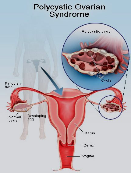 pcos treatment in homeopathy