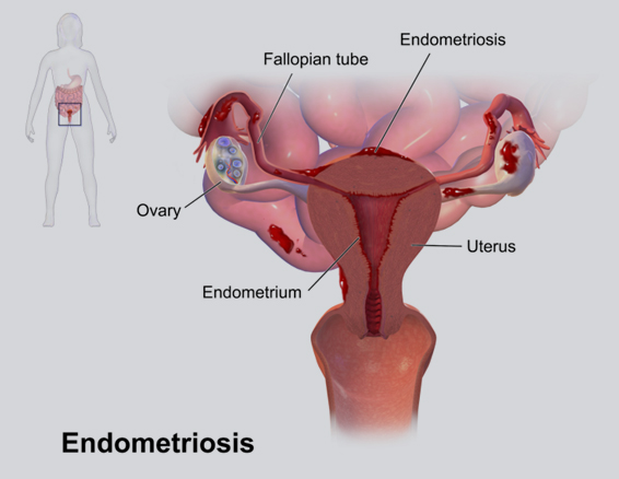 endometriosis treatment in homeopathy